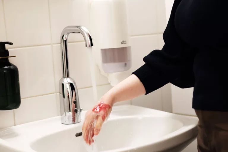 Person cools down a red burn under a running tap.